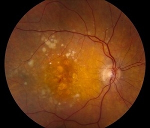 Early stage wet AMD
