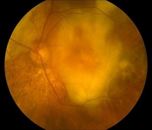 End stage wet AMD with scarring