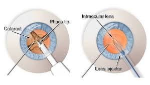Cataract surgery in mumbai